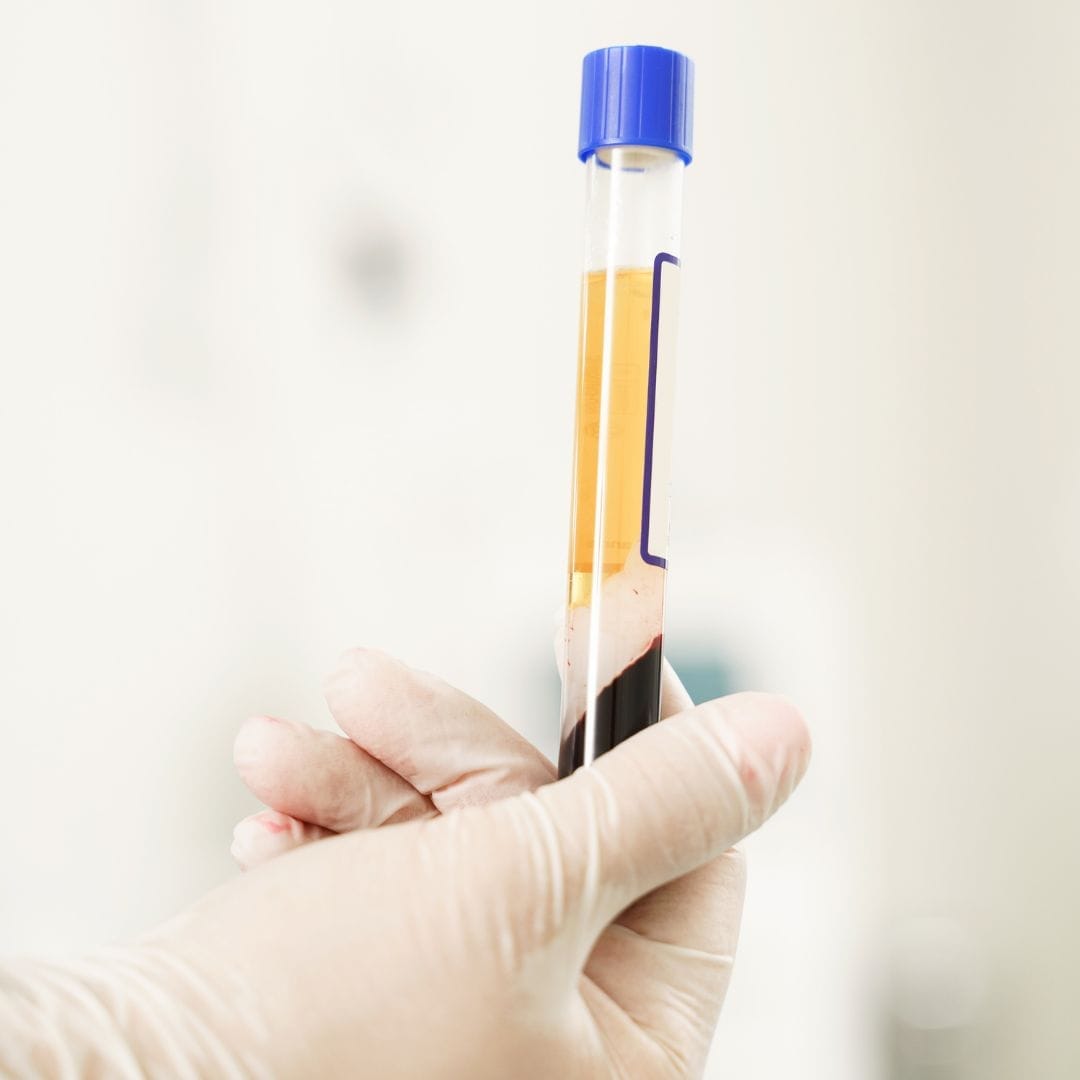 How Much Do PRP Injections Cost?