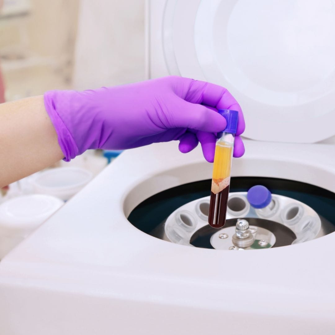 How Soon Can I Walk After PRP Injection?